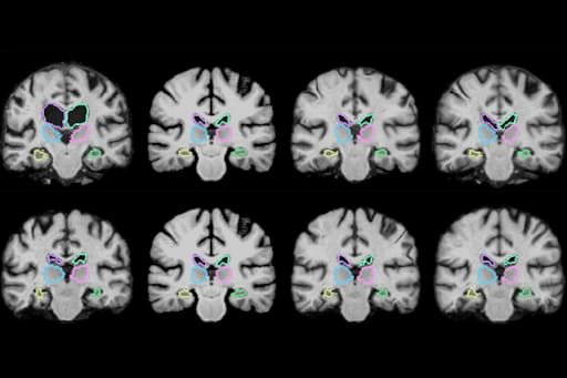 3D scans of brain analyzed by AI
